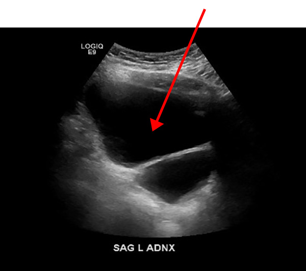 Anechoic - fluid (urine) in bladder.